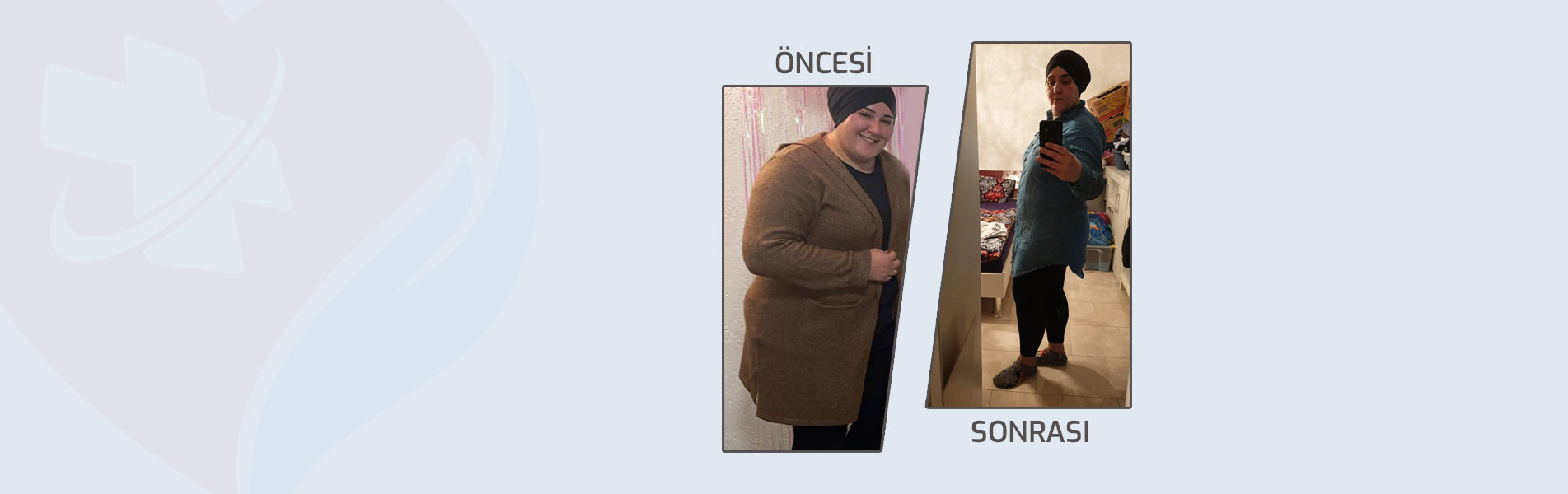 obezite-before-after1